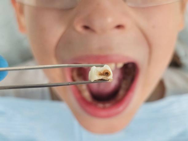 Best Knocked-Out Tooth (Avulsed Tooth) Treatment in Spurgeon, TN